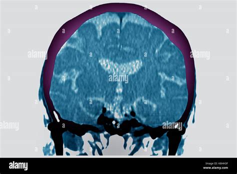 Cerebral Atrophy Ct Scan Stock Photo Alamy
