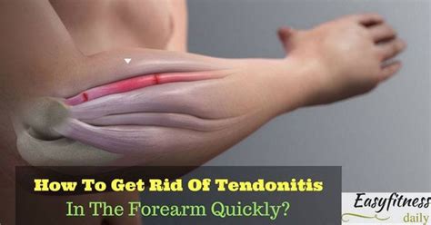 The tear creates swelling and pressure on the tendon which leads to inflammation and the symptoms of forearm tendonitis are the same as any other type of tendonitis (except calcific tendonitis). How To Get Rid Of Tendonitis In The Forearm Quickly? | Tendinitis, Forearm tendonitis, Tennis elbow