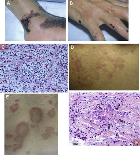 Eosinophil Related Disease And The Skin The Journal Of Allergy And