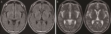 Figure 1 From De Novo Pineal Region Germinoma In The Seventh Decade Of