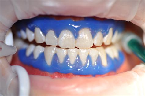 Denti Gialli Cosa Fare Studio Dentistico Dr Armando Giacomelli