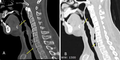 Retropharyngeal Abscess Radiology Cases