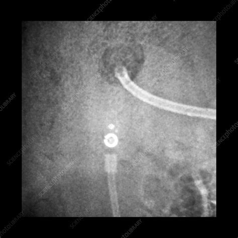 Programmable Shunt Valve X Ray Stock Image C0394272 Science