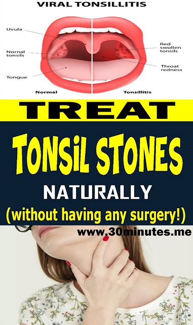 Treat Tonsil Stones Naturally Without Having Any Surgery Heres What