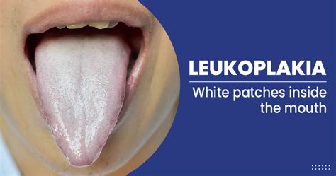 What Is Leukoplakia Leukoplakia Is A Condition That Causes White