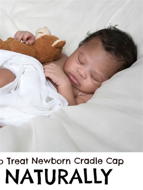 How To Use Coconut Oil To Treat Cradle Cap Adanna Dill