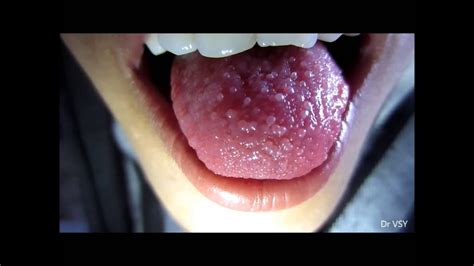 Papillitis Tongue Youtube