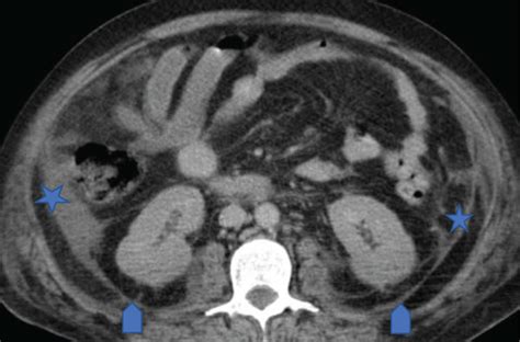 Axial Ct Image Of The Abdomen Through The Level Of The Kidneys Showing