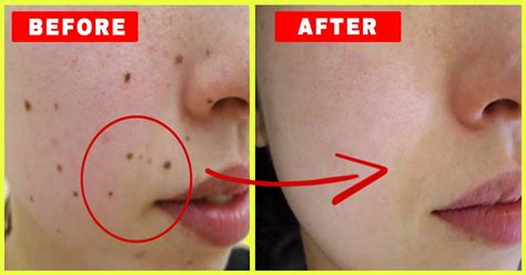 How To Remove Mole From Face Permanently Renew Physical Therapy