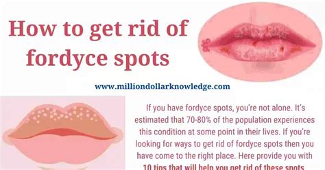 How To Get Rid Of Fordyce Spots 10 Best Remedies For Fordyce Spots Million Knowledge