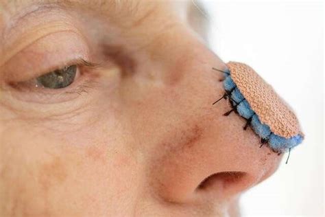Skin Graft On Nose Driving Me Nuts What Are The Causes And What To Do