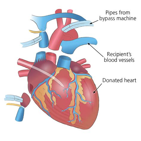 Heart Transplant Surgery Organ Transplantation Nhs Blood And Transplant