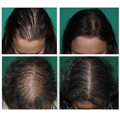 Details 73 Androgenic Alopecia Hairstyles Best Ineteachers