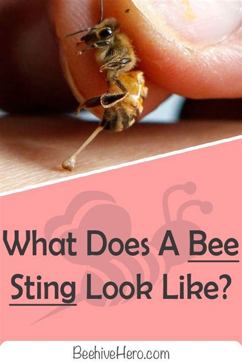 What Does A Bee Sting Look Like A Visual Guide Bee