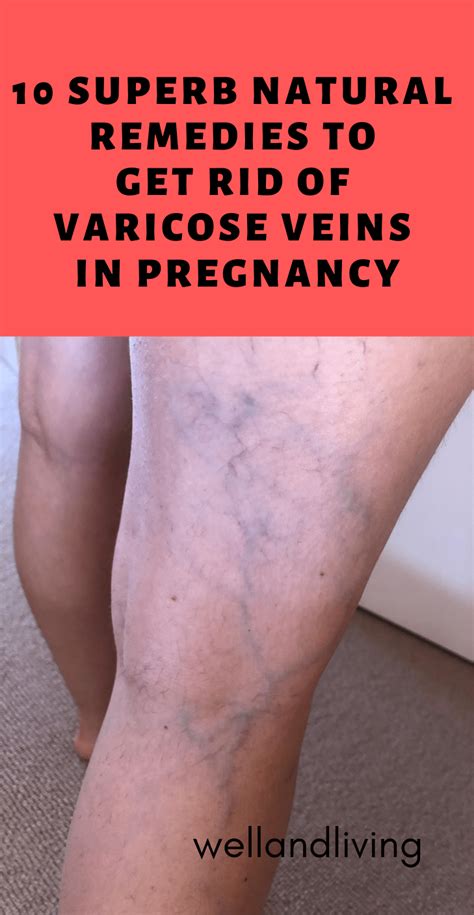 10 Superb Natural Remedies To Get Rid Of Varicose Veins In Pregnancy