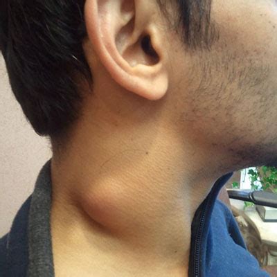 Cancerous Cyst On Neck