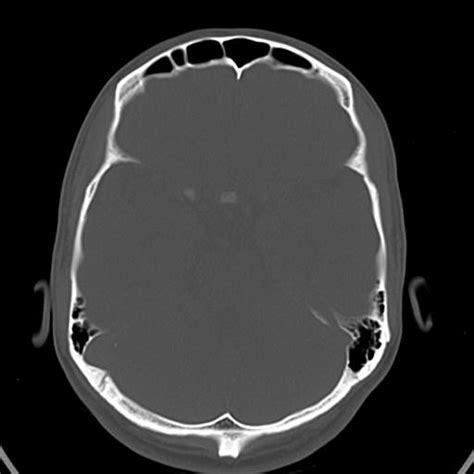 Occipital Spur Image