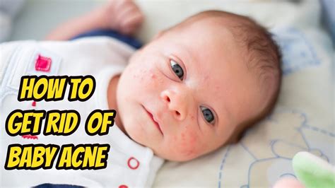Best Way How To Get Rid Of Baby Acne On Face In Newborn Youtube