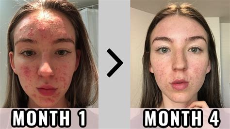My Accutane Experience Was It Worth It Youtube