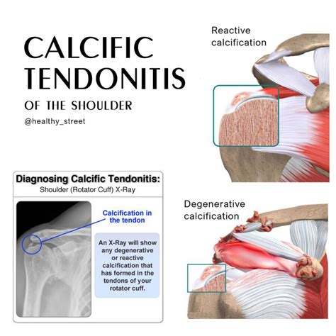 Calcific Tendonitis Sportsmd