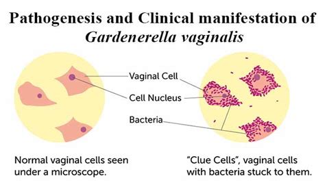 Solved The Causative Agent For Bacterial Vaginosis Is