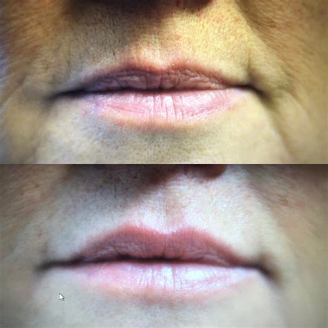 Juvederm Before And After Cleveland Ohio The Laser And Skin Surgery
