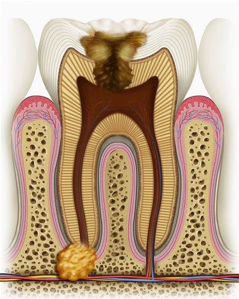 Cravo Para Dor De Dente