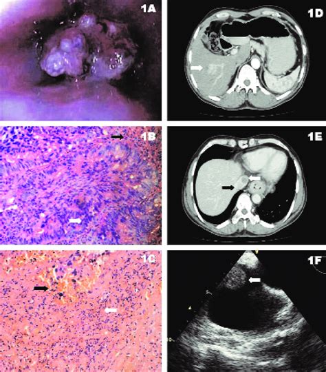 Esophageal Cancer With Hepatic Metastasis And Right Atrial Invasion By