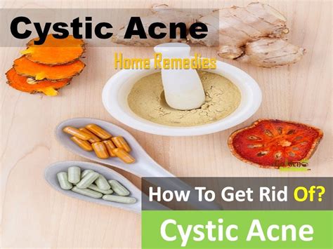 How To Get Rid Of Cystic Acne Home Remedies For Cystic Acne