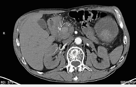 Ct Angiography Of The Abdomen And Pelvis Axial Cta Image Of The Abdomen