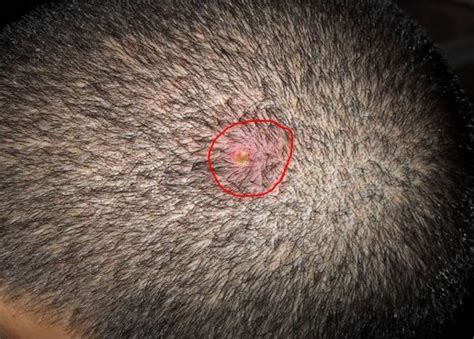 Small Painful Pimples On Scalp Hairlineand How To Get Rid Of Scalp Bumps