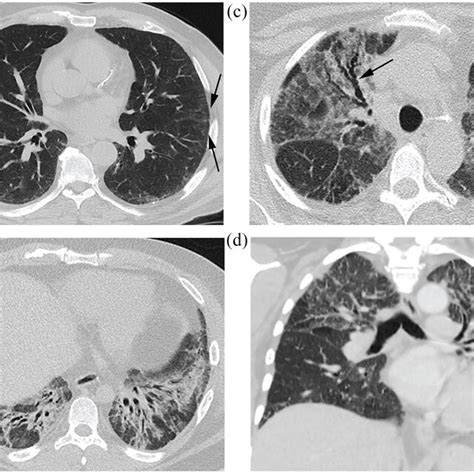 Typical Usual Interstitial Pneumonia Uip Pattern On High Resolution