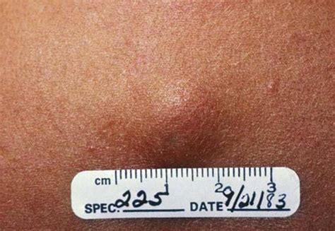 Benign Cysts Under Skin Dorothee Padraig South West Skin Health Care