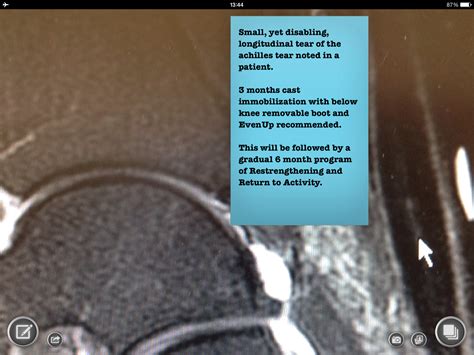 Foot And Ankle Problems By Dr Richard Blake Partial Rupture Achilles