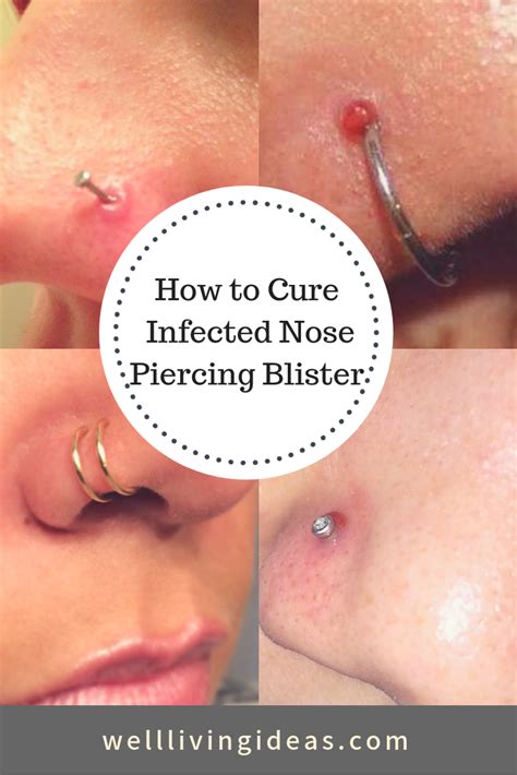 If you have tried all the remedies but cannot see any improvement after three weeks then you should consult your doctor. nose ring #nosering 10 Natural Home Remedies For Curing ...