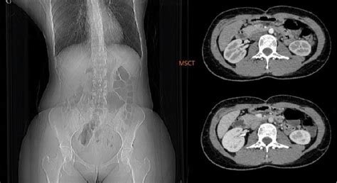 Latest Evaluation Of Abdominal Contrast Multislice Ct Msct With No