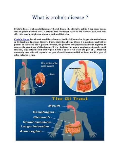Diagram Diagram Of Crohns Disease Mydiagramonline