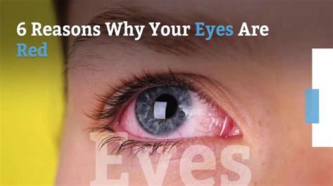 6 Reasons Your Eyes Are Red