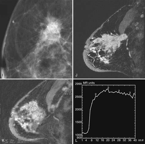 Mammographic And Ultrasound Analysis Of Breast Masses Radiology Key