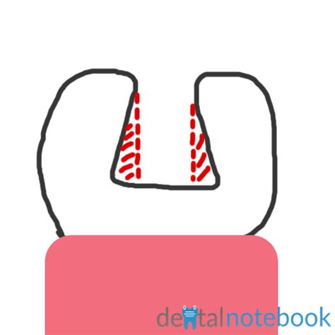 Key Concepts Of Amalgam Cavity Design Dentalnotebook