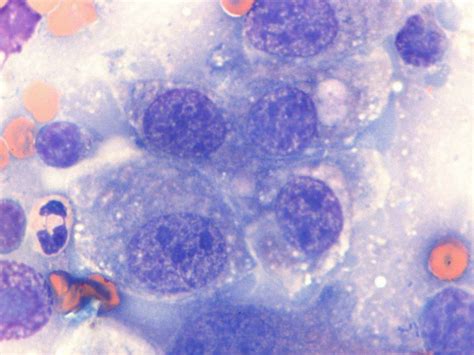Transitional Cell Carcinoma Tcc In A Dog Case Study Cytopath