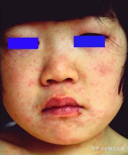 伴有发热的皮肤病（二）：发疹发热性传染病 知乎