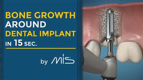 Bone Growth Around Dental Implants In Seconds Medical Technology