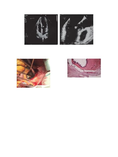 Pdf Cardiac Calcified Amorphous Tumor Of The Mitral Valve Presenting