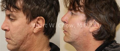 Acne Scar Treatment Before And After Photo Gallery San Francisco Ca