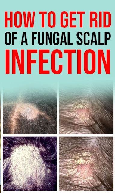 How To Get Rid Of A Fungal Scalp Infection Causes Symptoms And