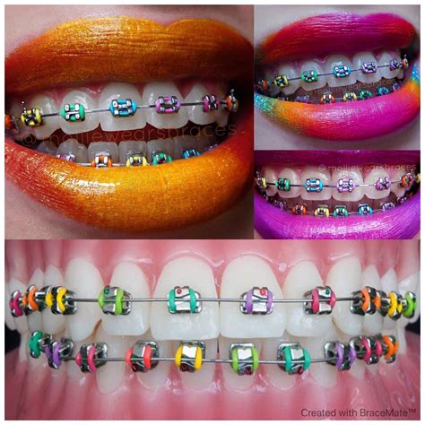 Colourful Braces Colours Bracemate Designs For Braces With Images