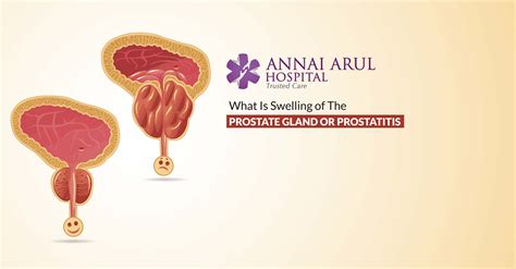 What Is Swelling Of The Prostate Gland Or Prostatitis Multispeciality Hospitals In Chennai