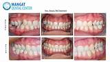 Images of Invisalign Tmj Treatment
