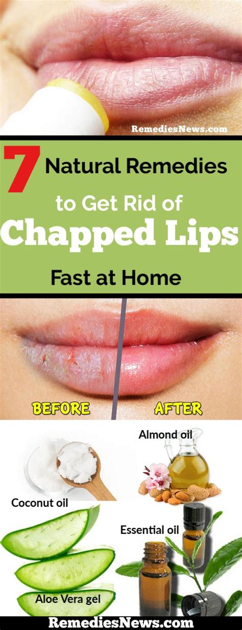 7 Natural Remedies To Get Rid Of Chapped Lips Fast At Home Dry